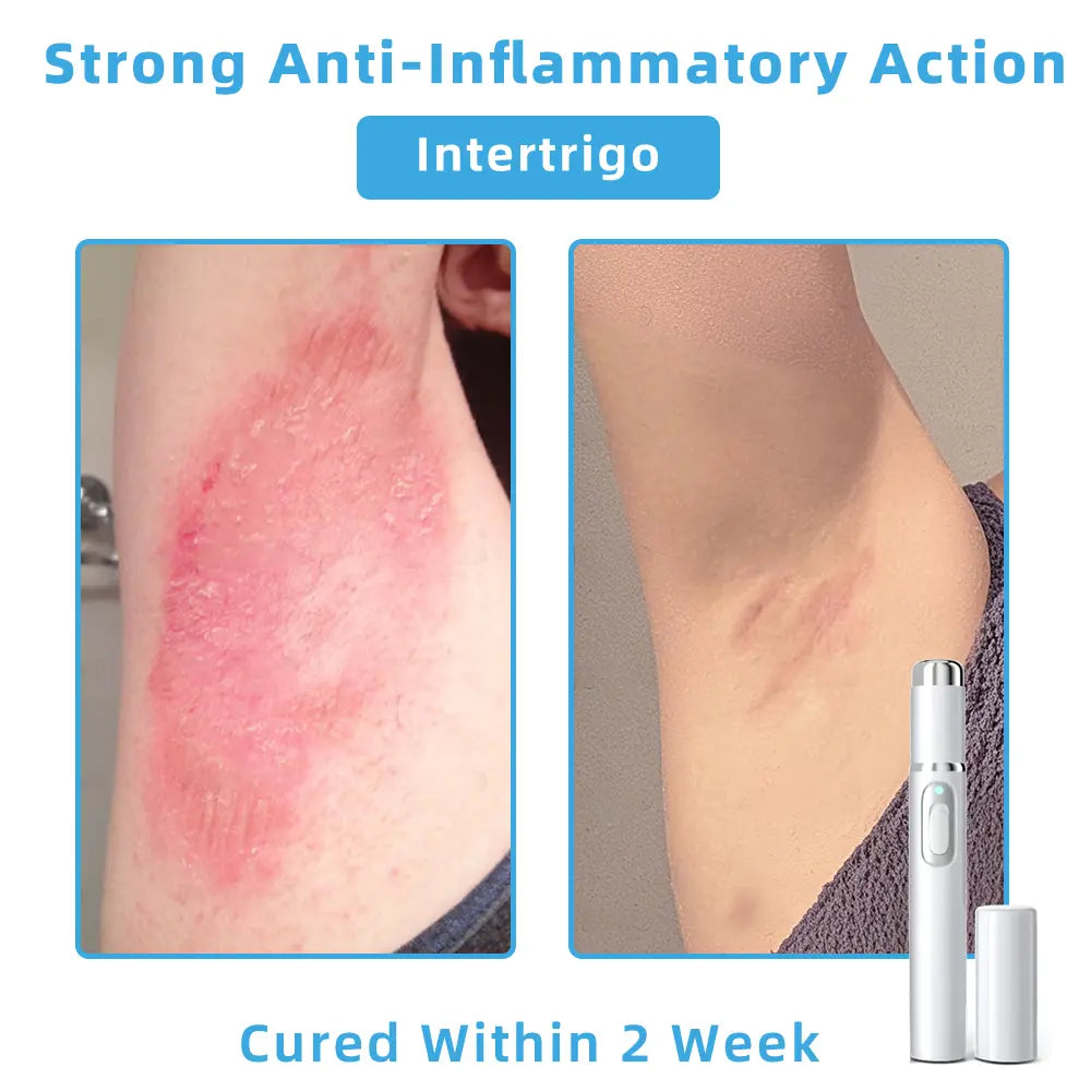 👩🏻⚕️Clinically Reviewed by Mayo Clinic Experts: Nuogea Non-invasive CO2 Mole and Wart Removal Laser Pen Promax (Fast and painless removal of warts, moles, age spots, and skin tags completely without side effects.)