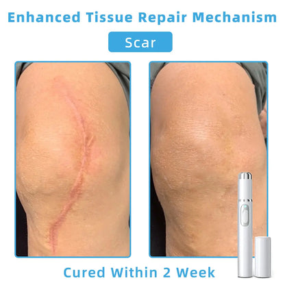 👩🏻‍⚕️Clinically Reviewed by Mayo Clinic Experts: Nuogea Non-invasive CO2 Mole and Wart Removal Laser Pen Promax (Fast and painless removal of warts, moles, age spots, and skin tags completely without side effects.)