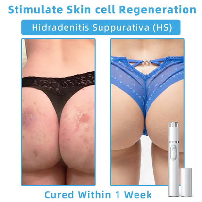 👩🏻‍⚕️Clinically Reviewed by Mayo Clinic Experts: Nuogea Non-invasive CO2 Mole and Wart Removal Laser Pen Promax (Fast and painless removal of warts, moles, age spots, and skin tags completely without side effects.)