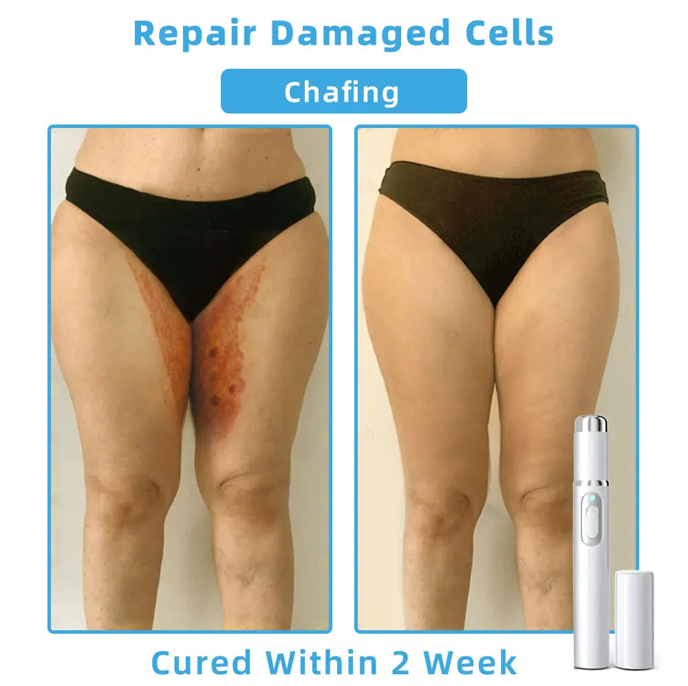 👩🏻‍⚕️Clinically Reviewed by Mayo Clinic Experts: Nuogea Non-invasive CO2 Mole and Wart Removal Laser Pen Promax (Fast and painless removal of warts, moles, age spots, and skin tags completely without side effects.)