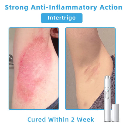 👩🏻‍⚕️Clinically Reviewed by Mayo Clinic Experts: Nuogea Non-invasive CO2 Mole and Wart Removal Laser Pen Promax (Fast and painless removal of warts, moles, age spots, and skin tags completely without side effects.)