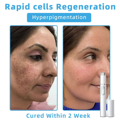 👩🏻‍⚕️Clinically Reviewed by Mayo Clinic Experts: Nuogea Non-invasive CO2 Mole and Wart Removal Laser Pen Promax (Fast and painless removal of warts, moles, age spots, and skin tags completely without side effects.)