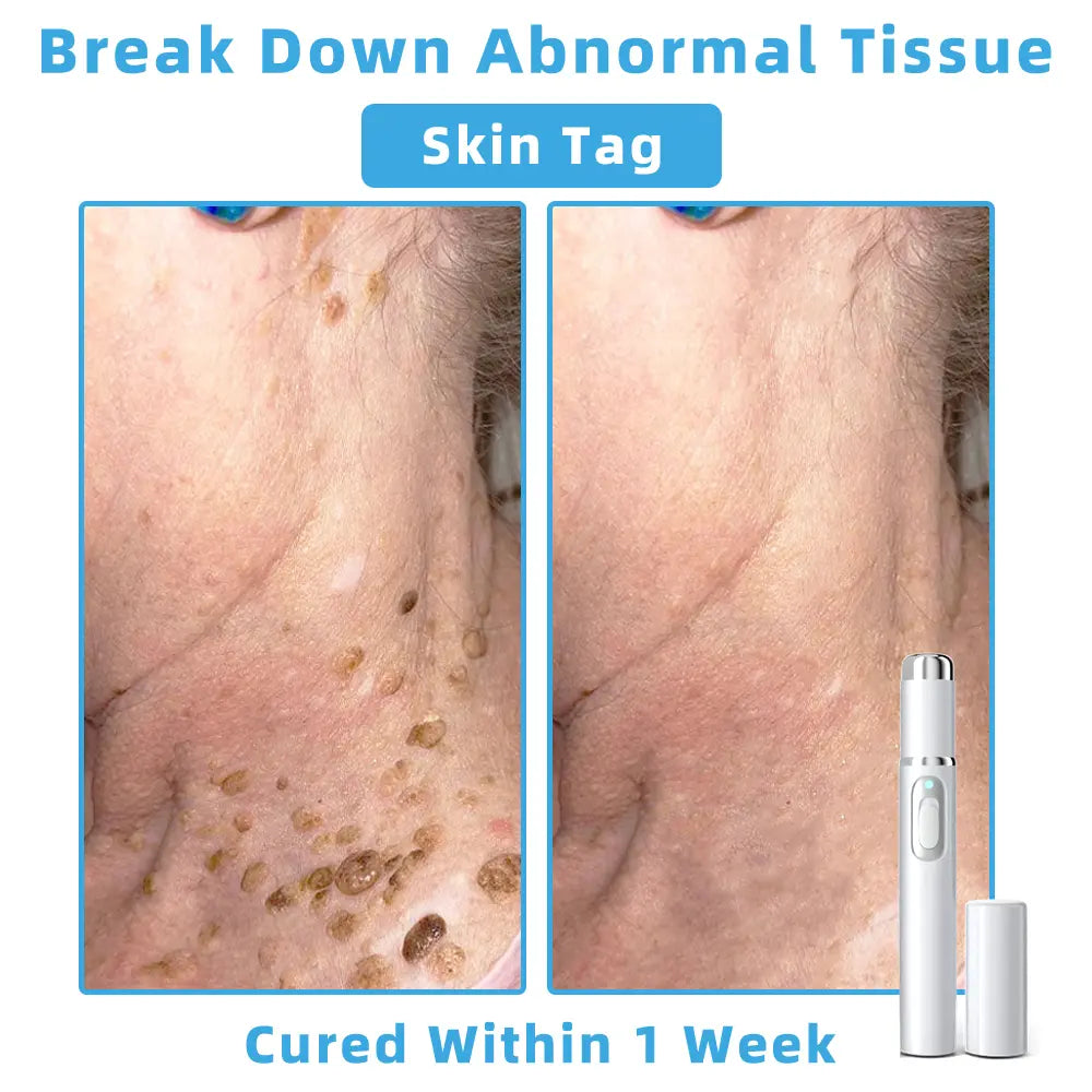 👩🏻‍⚕️Clinically Reviewed by Mayo Clinic Experts: Nuogea Non-invasive CO2 Mole and Wart Removal Laser Pen Promax (Fast and painless removal of warts, moles, age spots, and skin tags completely without side effects.)
