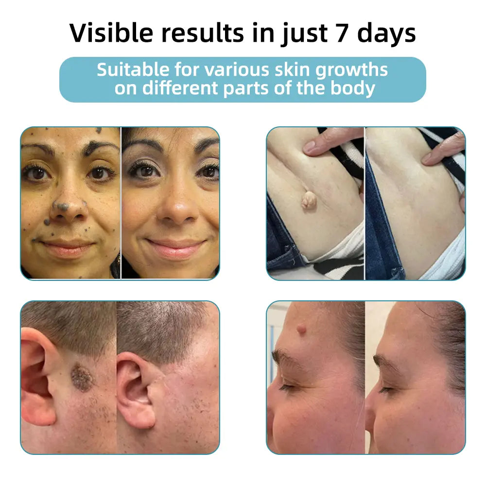 👩🏻‍⚕️Clinically Reviewed by Mayo Clinic Experts: Nuogea Non-invasive CO2 Mole and Wart Removal Laser Pen Promax (Fast and painless removal of warts, moles, age spots, and skin tags completely without side effects.)