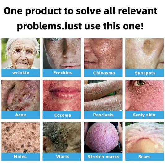 👩🏻‍⚕️Clinically Reviewed by Mayo Clinic Experts: Nuogea Non-invasive CO2 Mole and Wart Removal Laser Pen Promax (Fast and painless removal of warts, moles, age spots, and skin tags completely without side effects.)