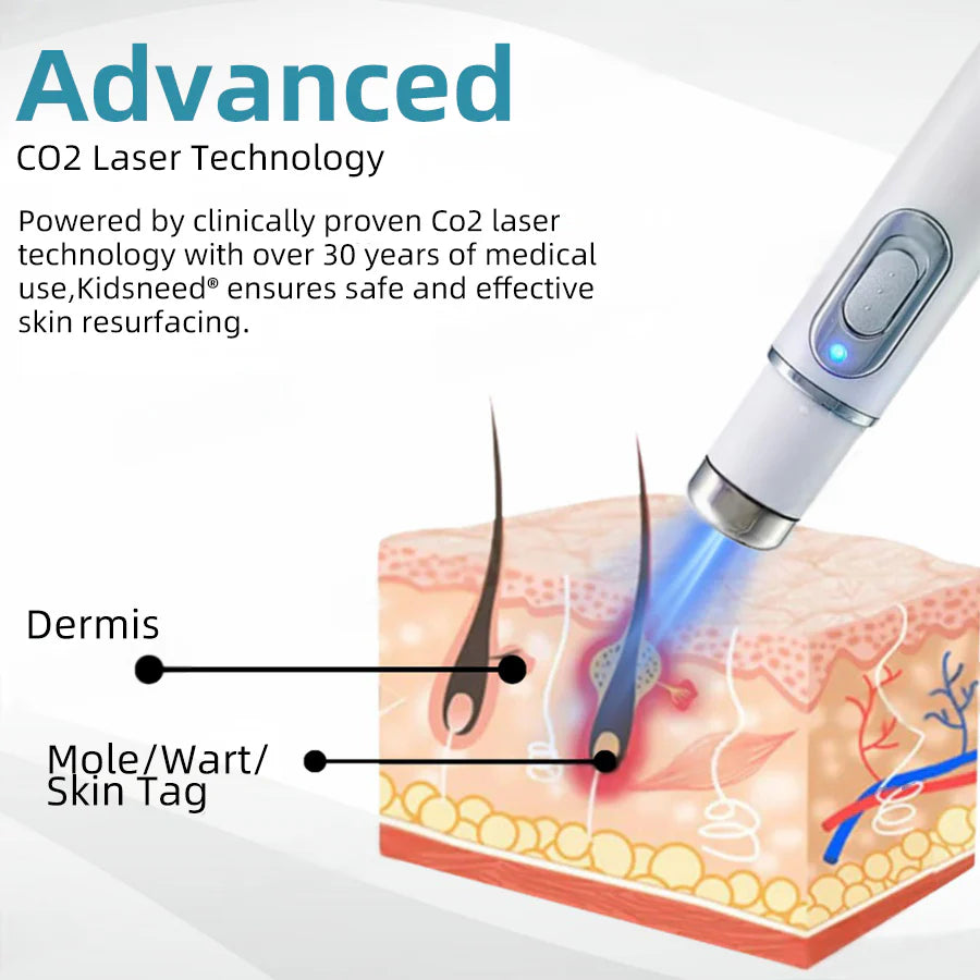 👩🏻‍⚕️Clinically Reviewed by Mayo Clinic Experts: Nuogea Non-invasive CO2 Mole and Wart Removal Laser Pen Promax (Fast and painless removal of warts, moles, age spots, and skin tags completely without side effects.)